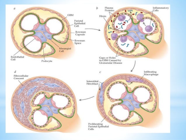 RAPIDLY PROGRESSIVE GLOMERULONEPHRITIS(RPGN)