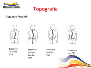 Topografia
    Segundo Posenti:



 




      Escoliose        Escoliose   Escoliose   Escoliose
      Torácica         Tóraco-     Lombar      em “S”
      25%              Lombar      25%         30%
                       19%
 
