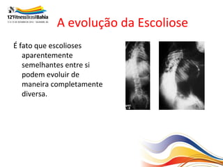 A evolução da Escoliose
É fato que escolioses
   aparentemente
   semelhantes entre si
   podem evoluir de
   maneira completamente
   diversa.
 