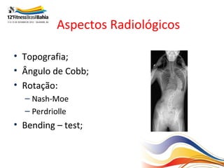 Aspectos Radiológicos

• Topografia;
• Ângulo de Cobb;
• Rotação:
  – Nash-Moe
  – Perdriolle
• Bending – test;
 