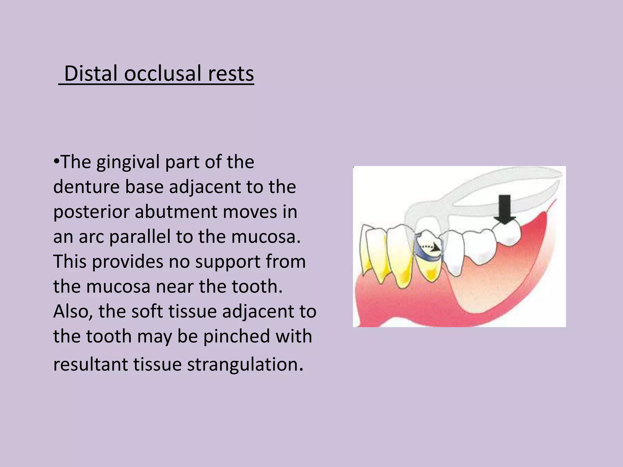 Distal occlusal rests
•The gingival part of the
denture base adjacent to the
posterior abutment moves in
an arc parallel to the mucosa.
This provides no support from
the mucosa near the tooth.
Also, the soft tissue adjacent to
the tooth may be pinched with
resultant tissue strangulation.
 