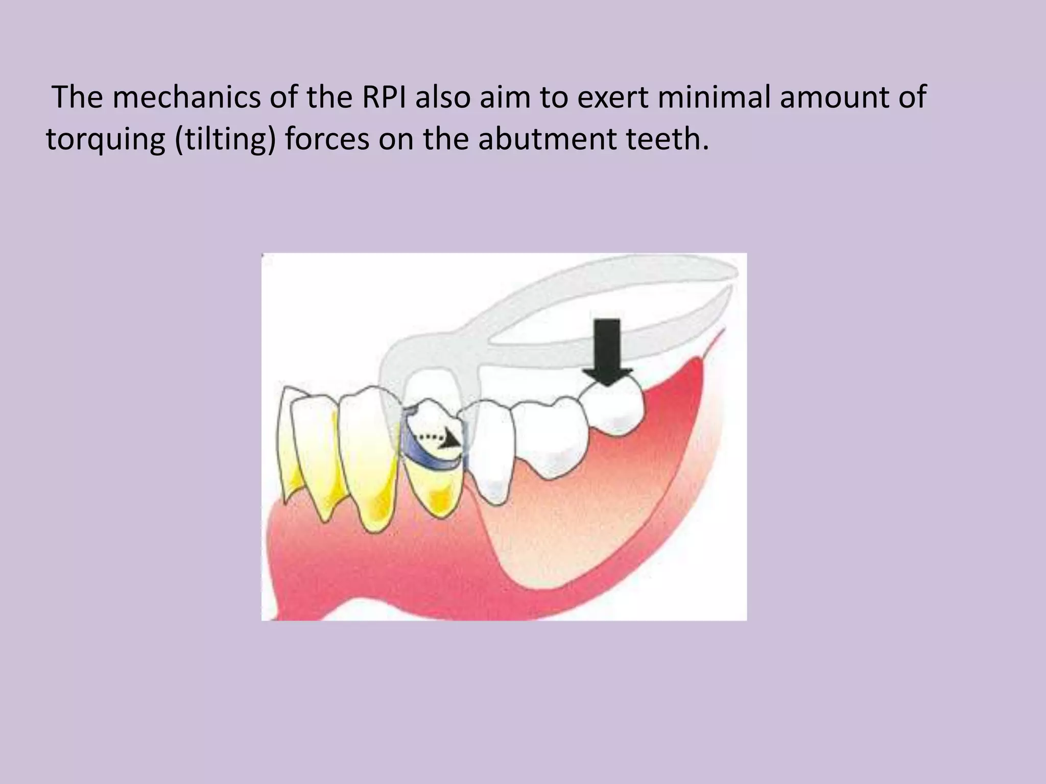 The mechanics of the RPI also aim to exert minimal amount of
torquing (tilting) forces on the abutment teeth.
 