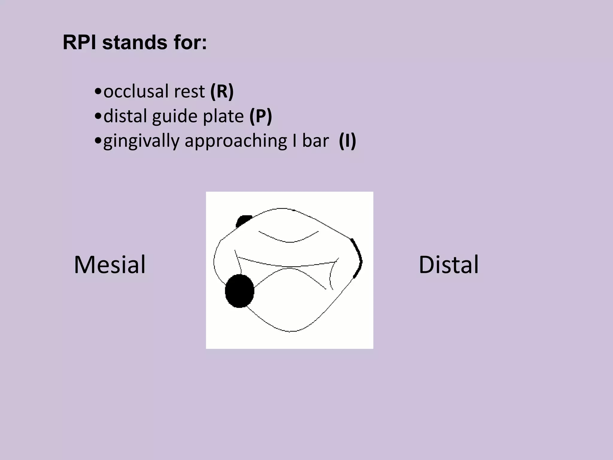 RPI stands for:
•occlusal rest (R)
•distal guide plate (P)
•gingivally approaching I bar (I)
Mesial Distal
 