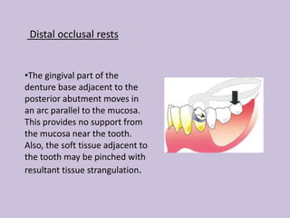 Distal occlusal rests
•The gingival part of the
denture base adjacent to the
posterior abutment moves in
an arc parallel to the mucosa.
This provides no support from
the mucosa near the tooth.
Also, the soft tissue adjacent to
the tooth may be pinched with
resultant tissue strangulation.
 