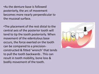 •As the denture base is followed
posteriorly, the arc of movement
becomes more nearly perpendicular to
the mucosal surface.
•The placement of the rest distal to the
central axis of the posterior tooth will
tend to tip the tooth posteriorly. When
movement of the edentulous base
occurs, the force exerted on the tooth
can be compared to a precision-
constructed & fitted ‘wrench’ that tends
to pull the tooth backwards . This can
result in tooth mobility, bone loss &
bodily movement of the tooth.
 