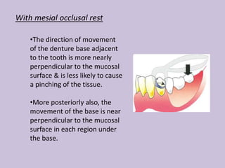 With mesial occlusal rest
•The direction of movement
of the denture base adjacent
to the tooth is more nearly
perpendicular to the mucosal
surface & is less likely to cause
a pinching of the tissue.
•More posteriorly also, the
movement of the base is near
perpendicular to the mucosal
surface in each region under
the base.
 
