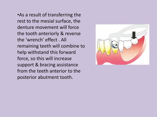 •As a result of transferring the
rest to the mesial surface, the
denture movement will force
the tooth anteriorly & reverse
the ‘wrench’ effect . All
remaining teeth will combine to
help withstand this forward
force, so this will increase
support & bracing assistance
from the teeth anterior to the
posterior abutment tooth.
 
