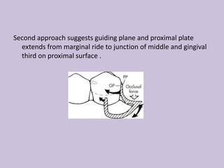 Second approach suggests guiding plane and proximal plate
extends from marginal ride to junction of middle and gingival
third on proximal surface .
 