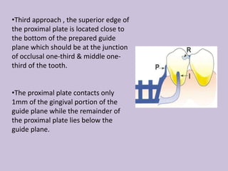 •Third approach , the superior edge of
the proximal plate is located close to
the bottom of the prepared guide
plane which should be at the junction
of occlusal one-third & middle one-
third of the tooth.
•The proximal plate contacts only
1mm of the gingival portion of the
guide plane while the remainder of
the proximal plate lies below the
guide plane.
 