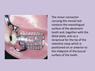 The minor connector
carrying the mesial rest
contacts the mesiolingual
surface of the abutment
tooth and, together with the
distal plate, acts as a
reciprocal for the tip of the
retentive clasp which is
positioned on or anterior to
the midpoint of the buccal
surface of the tooth.
 