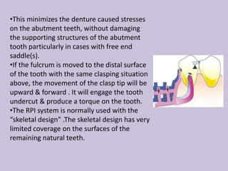 •This minimizes the denture caused stresses
on the abutment teeth, without damaging
the supporting structures of the abutment
tooth particularly in cases with free end
saddle(s).
•If the fulcrum is moved to the distal surface
of the tooth with the same clasping situation
above, the movement of the clasp tip will be
upward & forward . It will engage the tooth
undercut & produce a torque on the tooth.
•The RPI system is normally used with the
“skeletal design” .The skeletal design has very
limited coverage on the surfaces of the
remaining natural teeth.
 