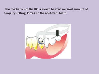 The mechanics of the RPI also aim to exert minimal amount of
torquing (tilting) forces on the abutment teeth.
 