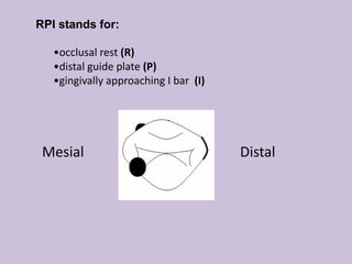 RPI stands for:
•occlusal rest (R)
•distal guide plate (P)
•gingivally approaching I bar (I)
Mesial Distal
 