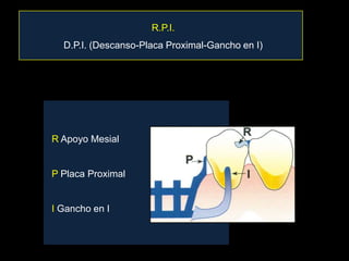 Rpcvs Rpi Dentures Rpi, r. indirecta, bases, prueba estructura | PPTX