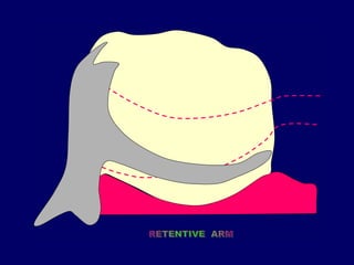 Rpcvs Rpi Dentures Rpi & rpa kk | PPTX