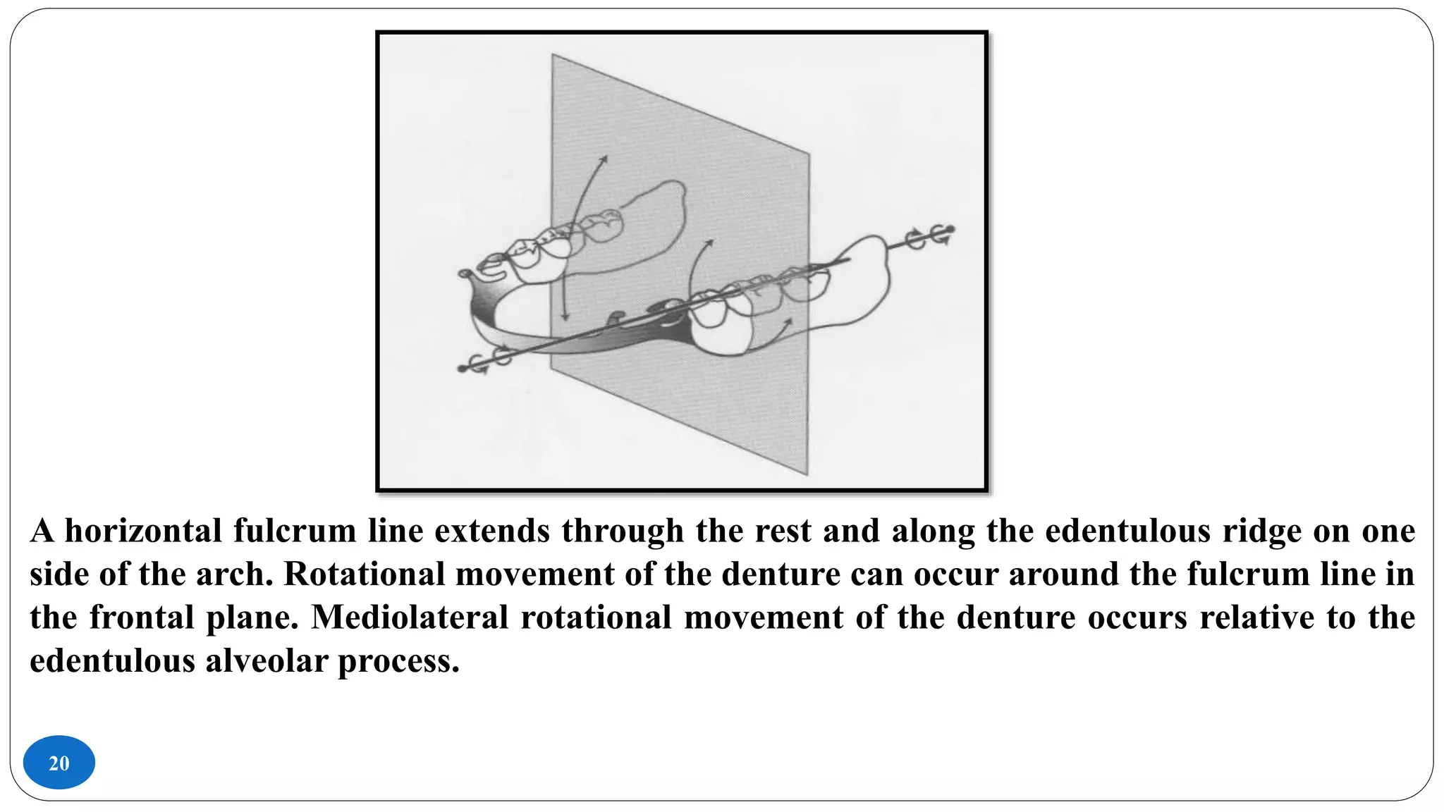 20
A horizontal fulcrum line extends through the rest and along the edentulous ridge on one
side of the arch. Rotational movement of the denture can occur around the fulcrum line in
the frontal plane. Mediolateral rotational movement of the denture occurs relative to the
edentulous alveolar process.
 