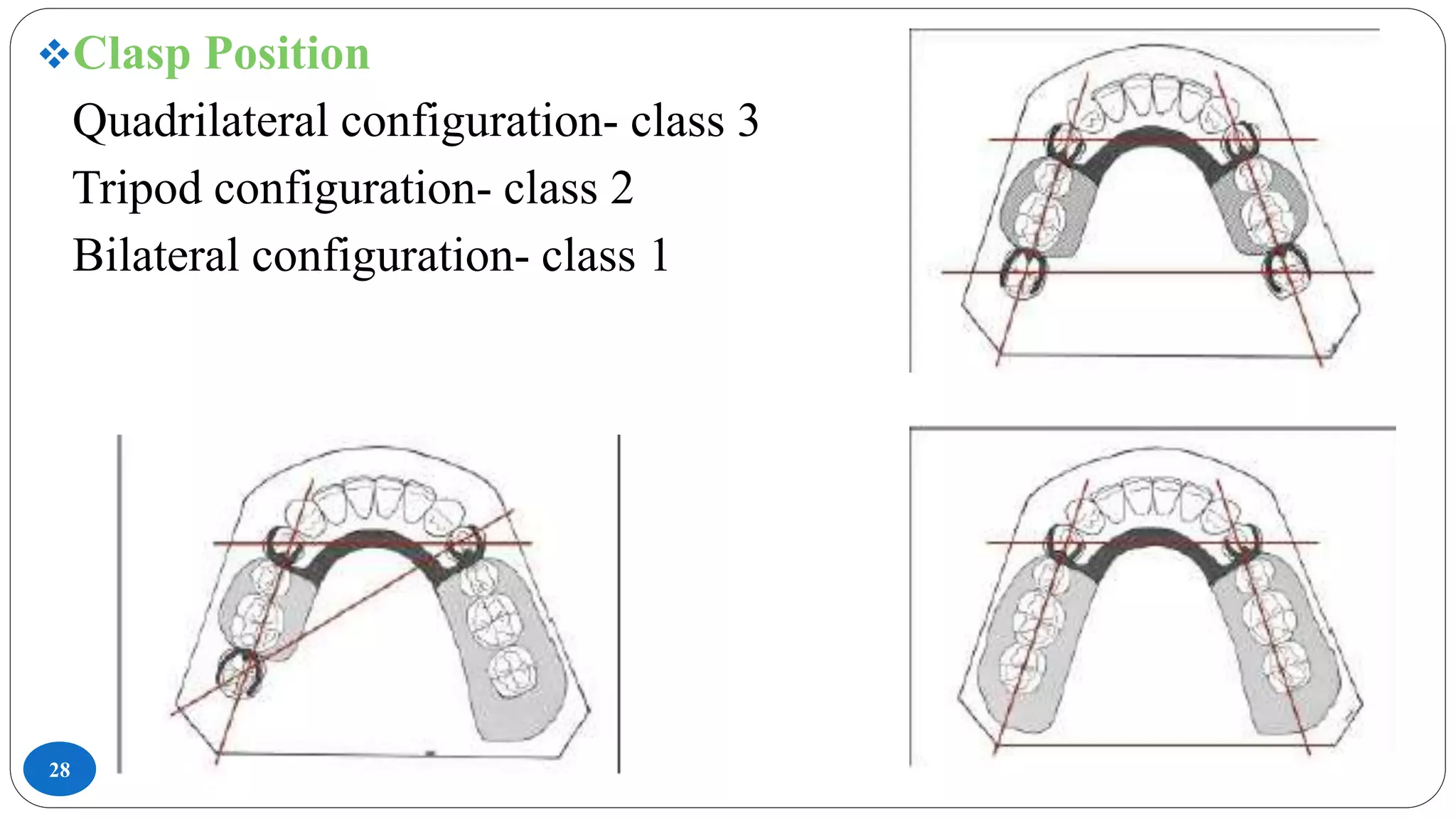 28
Clasp Position
Quadrilateral configuration- class 3
Tripod configuration- class 2
Bilateral configuration- class 1
 