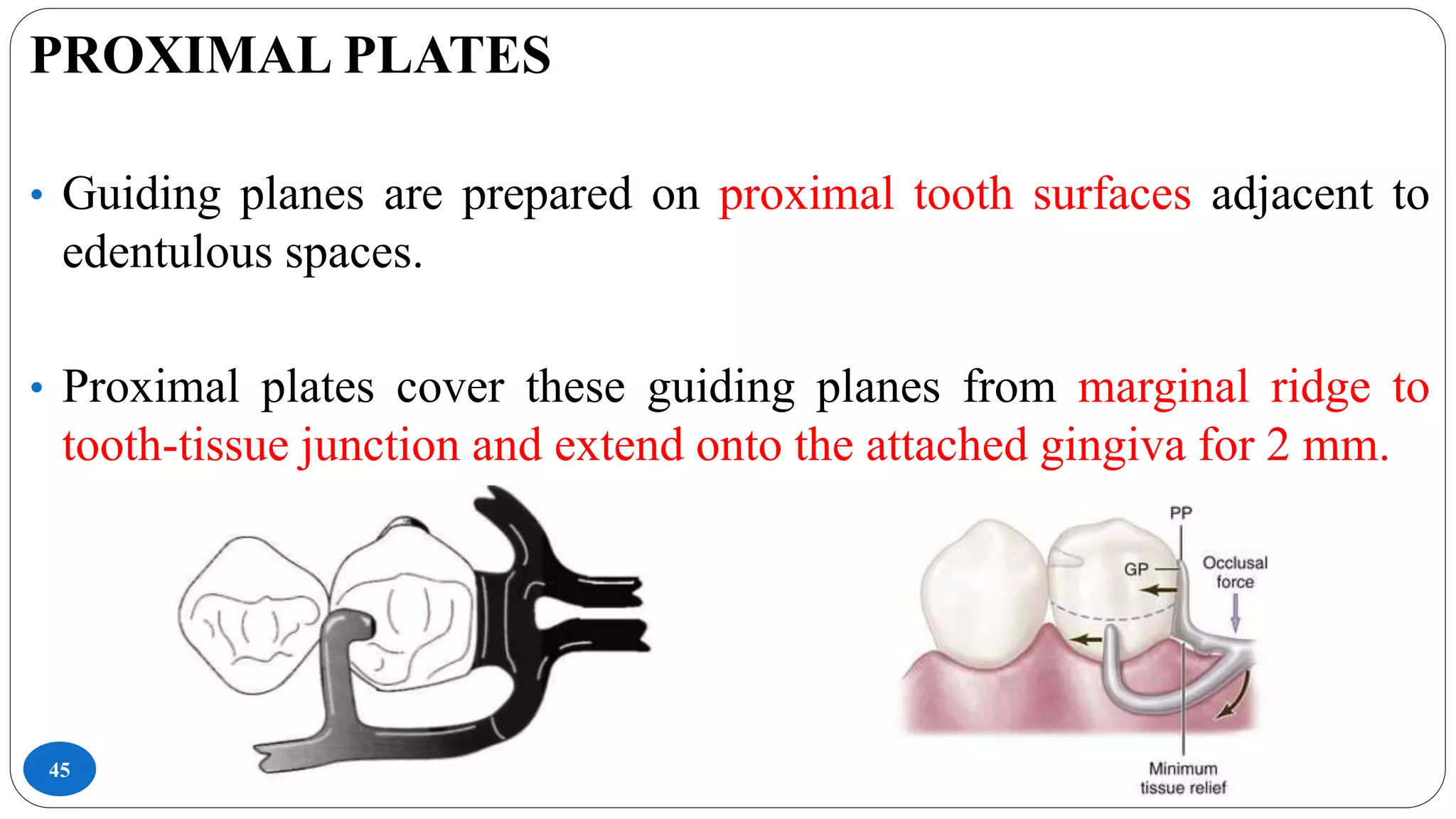 45
PROXIMAL PLATES
• Guiding planes are prepared on proximal tooth surfaces adjacent to
edentulous spaces.
• Proximal plates cover these guiding planes from marginal ridge to
tooth-tissue junction and extend onto the attached gingiva for 2 mm.
 