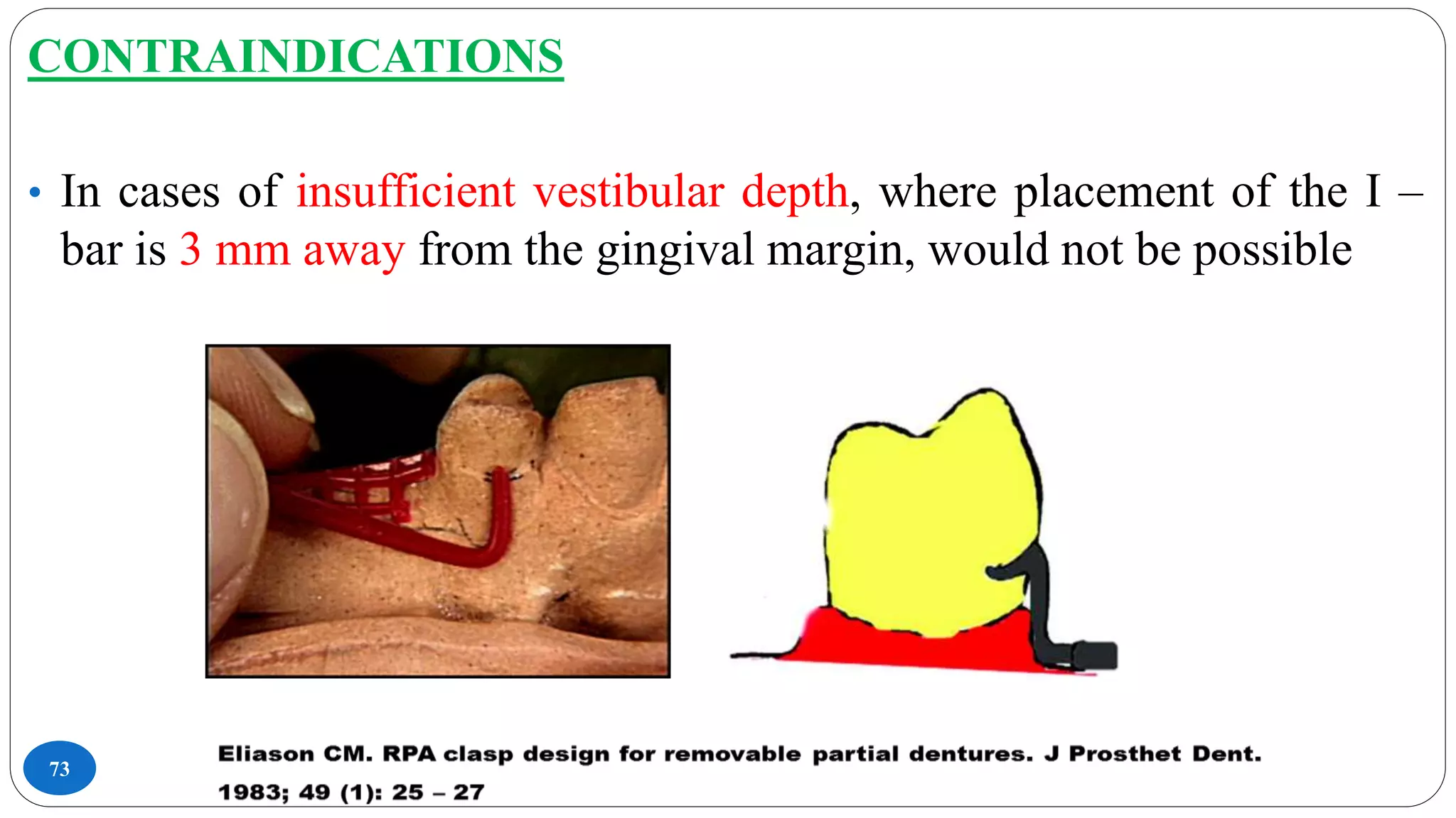 73
CONTRAINDICATIONS
• In cases of insufficient vestibular depth, where placement of the I –
bar is 3 mm away from the gingival margin, would not be possible
 