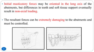 11
• Initial masticatory forces may be oriented in the long axis of the
abutments, but differences in tooth and soft tissue support eventually
result in non-axial loading.
• The resultant forces can be extremely damaging to the abutments and
must be controlled.
 
