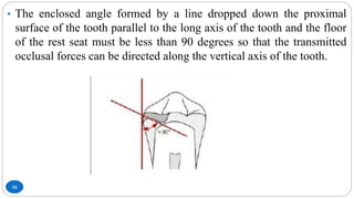 16
• The enclosed angle formed by a line dropped down the proximal
surface of the tooth parallel to the long axis of the tooth and the floor
of the rest seat must be less than 90 degrees so that the transmitted
occlusal forces can be directed along the vertical axis of the tooth.
 