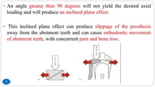 17
• An angle greater than 90 degrees will not yield the desired axial
loading and will produce an inclined plane effect.
• This inclined plane effect can produce slippage of the prosthesis
away from the abutment teeth and can cause orthodontic movement
of abutment teeth, with concurrent pain and bone loss.
 