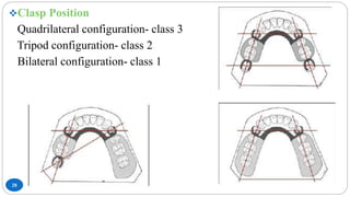 28
Clasp Position
Quadrilateral configuration- class 3
Tripod configuration- class 2
Bilateral configuration- class 1
 