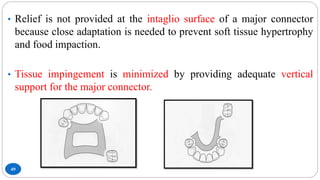 49
• Relief is not provided at the intaglio surface of a major connector
because close adaptation is needed to prevent soft tissue hypertrophy
and food impaction.
• Tissue impingement is minimized by providing adequate vertical
support for the major connector.
 
