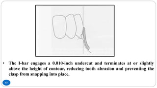 53
• The I-bar engages a 0.010-inch undercut and terminates at or slightly
above the height of contour, reducing tooth abrasion and preventing the
clasp from snapping into place.
 