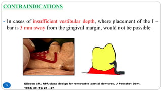 73
CONTRAINDICATIONS
• In cases of insufficient vestibular depth, where placement of the I –
bar is 3 mm away from the gingival margin, would not be possible
 