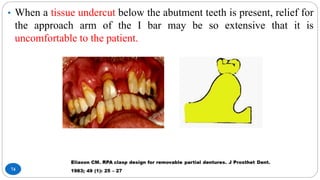 74
• When a tissue undercut below the abutment teeth is present, relief for
the approach arm of the I bar may be so extensive that it is
uncomfortable to the patient.
 