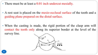 81
• There must be at least a 0.01 inch undercut mesially.
• A rest seat is placed on the mesio-occlusal surface of the tooth and a
guiding plane prepared on the distal surface.
• When the casting is made, the rigid portion of the clasp arm will
contact the tooth only along its superior border at the level of the
survey line.
 