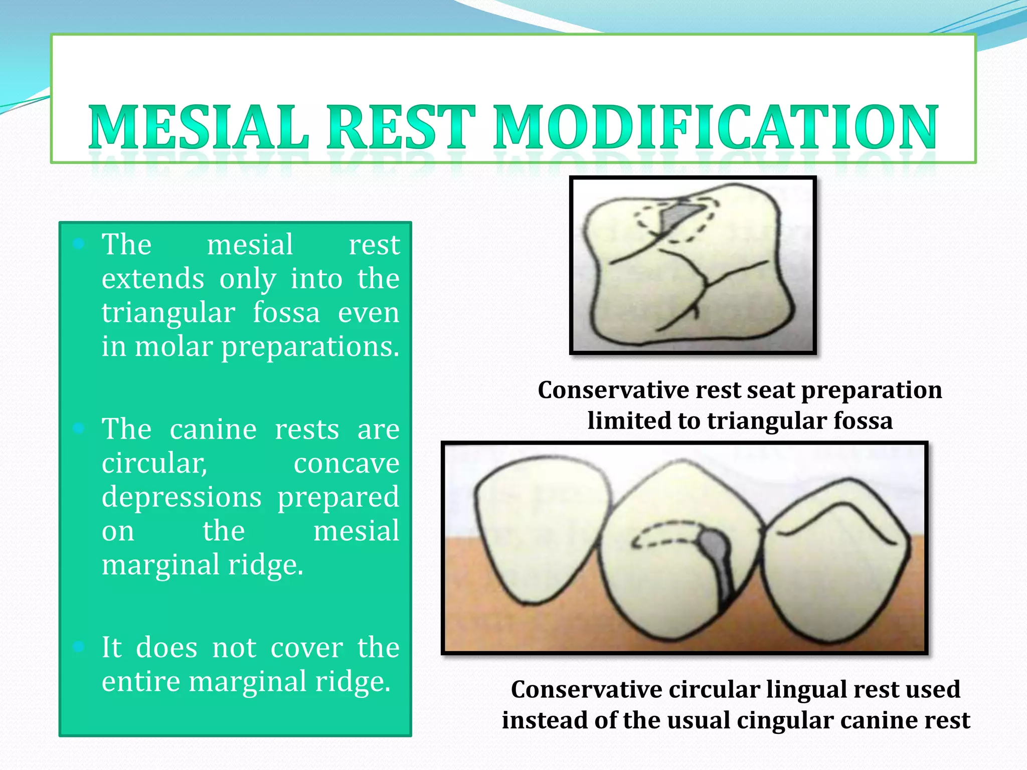  The     mesial    rest
  extends only into the
  triangular fossa even
  in molar preparations.
                              Conservative rest seat preparation
 The canine rests are           limited to triangular fossa
  circular,     concave
  depressions prepared
  on      the     mesial
  marginal ridge.

 It does not cover the
  entire marginal ridge.    Conservative circular lingual rest used
                           instead of the usual cingular canine rest
 