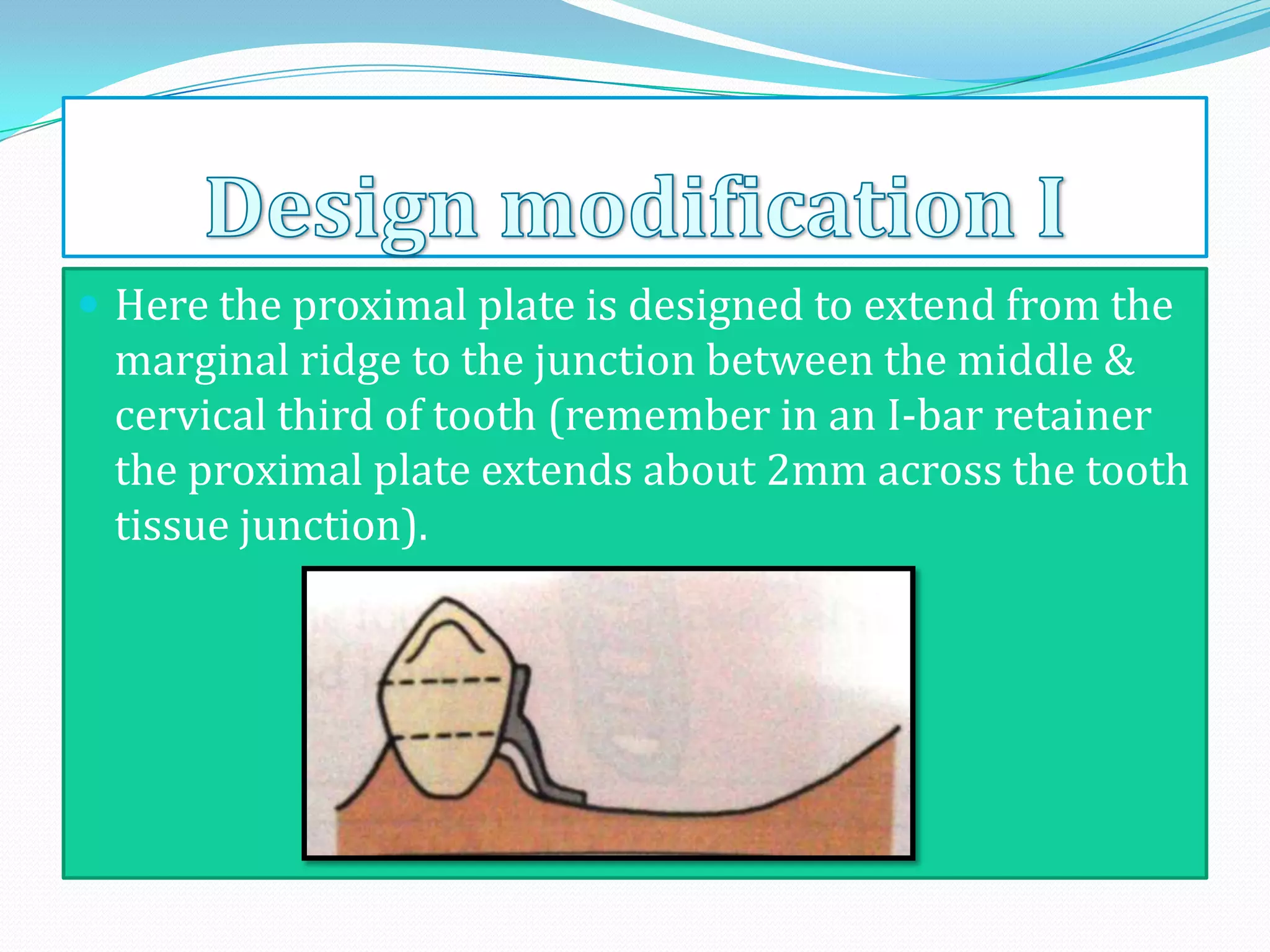  Here the proximal plate is designed to extend from the
 marginal ridge to the junction between the middle &
 cervical third of tooth (remember in an I-bar retainer
 the proximal plate extends about 2mm across the tooth
 tissue junction).
 