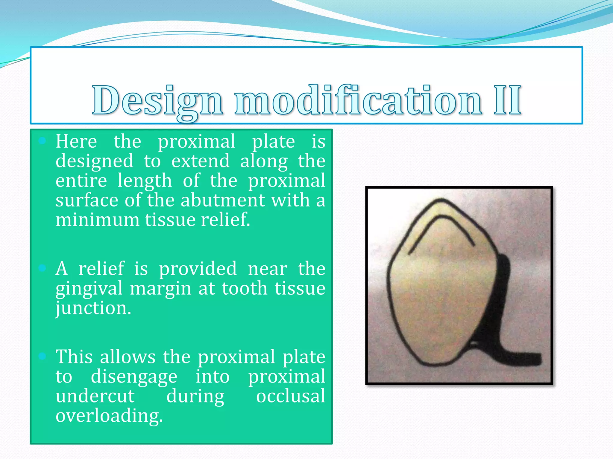  Here the proximal plate is
  designed to extend along the
  entire length of the proximal
  surface of the abutment with a
  minimum tissue relief.

 A relief is provided near the
  gingival margin at tooth tissue
  junction.

 This allows the proximal plate
  to disengage into proximal
  undercut     during occlusal
  overloading.
 