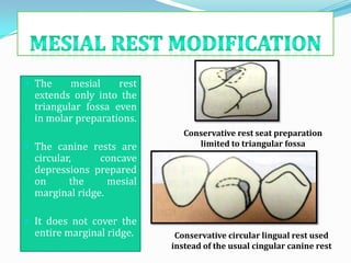  The     mesial    rest
  extends only into the
  triangular fossa even
  in molar preparations.
                              Conservative rest seat preparation
 The canine rests are           limited to triangular fossa
  circular,     concave
  depressions prepared
  on      the     mesial
  marginal ridge.

 It does not cover the
  entire marginal ridge.    Conservative circular lingual rest used
                           instead of the usual cingular canine rest
 