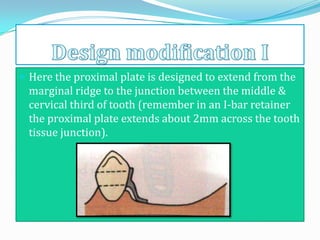  Here the proximal plate is designed to extend from the
 marginal ridge to the junction between the middle &
 cervical third of tooth (remember in an I-bar retainer
 the proximal plate extends about 2mm across the tooth
 tissue junction).
 