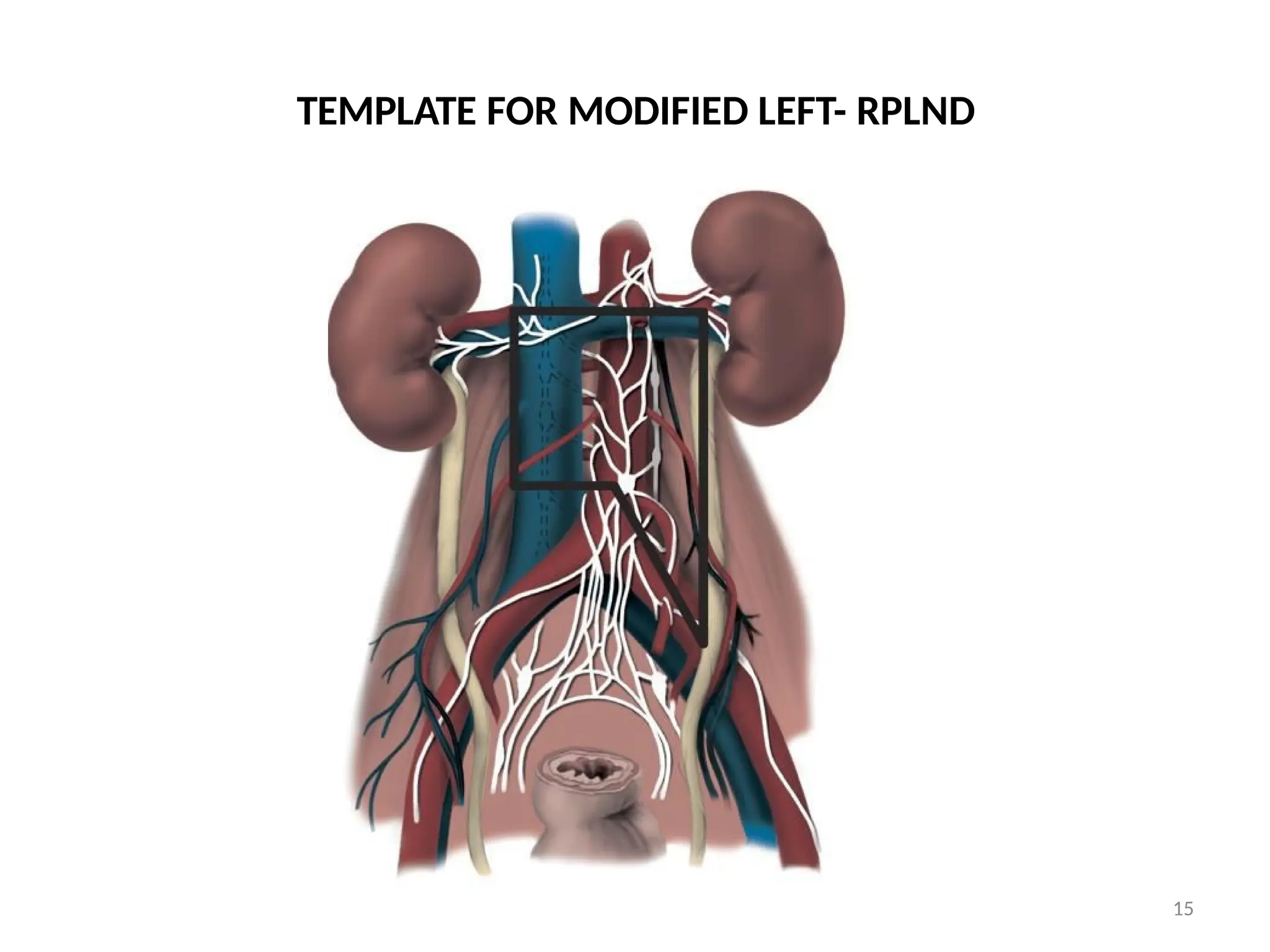 TEMPLATE FOR MODIFIED LEFT- RPLND
15
 