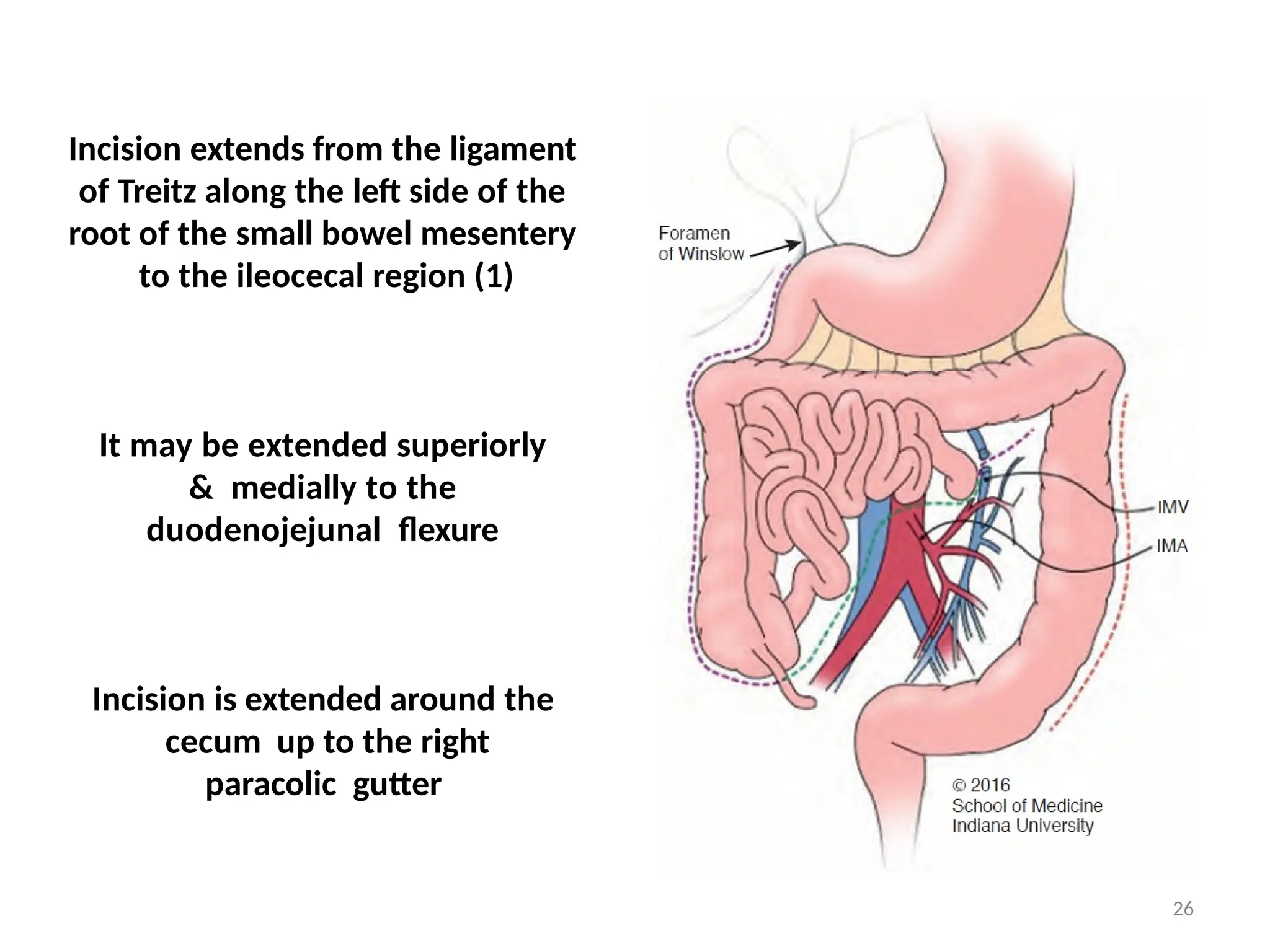 Incision extends from the ligament
of Treitz along the left side of the
root of the small bowel mesentery
to the ileocecal region (1)
It may be extended superiorly
& medially to the
duodenojejunal flexure
Incision is extended around the
cecum up to the right
paracolic gutter
26
 