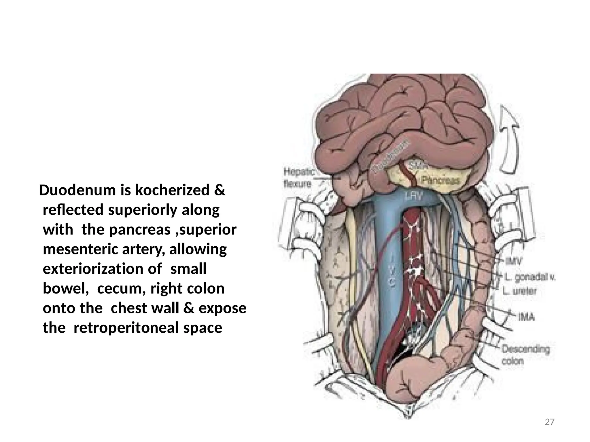 Duodenum is kocherized &
reflected superiorly along
with the pancreas ,superior
mesenteric artery, allowing
exteriorization of small
bowel, cecum, right colon
onto the chest wall & expose
the retroperitoneal space
27
 