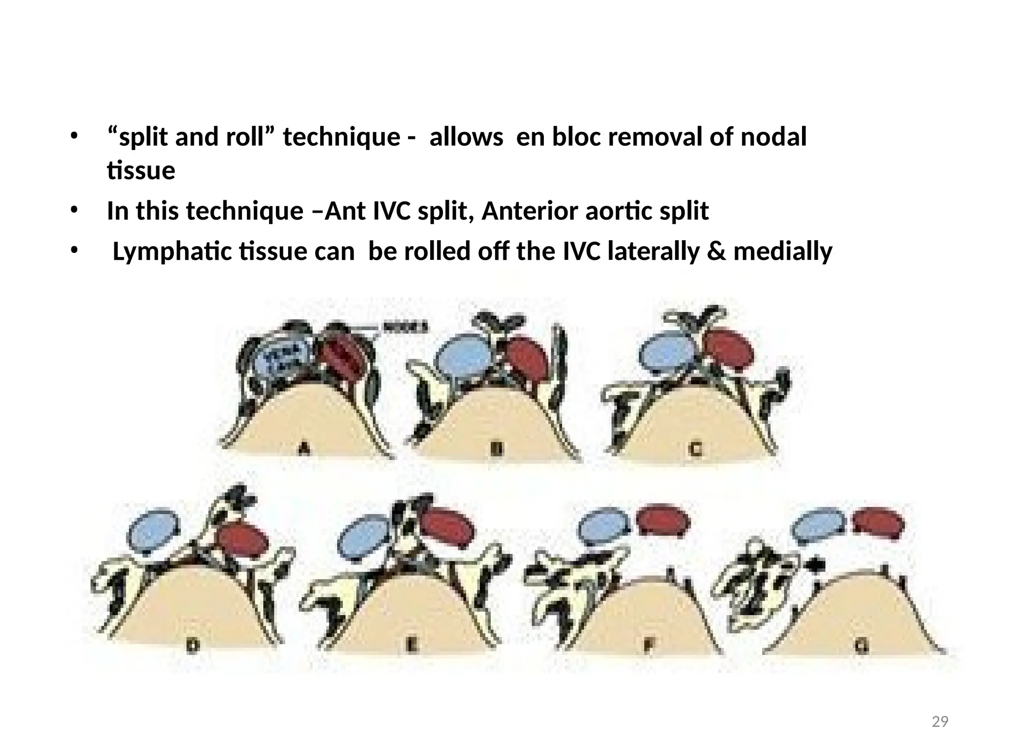 • “split and roll” technique - allows en bloc removal of nodal
tissue
• In this technique –Ant IVC split, Anterior aortic split
• Lymphatic tissue can be rolled off the IVC laterally & medially
• Lumbar veins are doubly ligated & divided
29
 