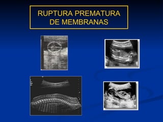 RUPTURA PREMATURA DE MEMBRANAS 