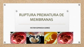 RUPTURA PREMATURA DE
MEMBRANAS
VICTOR ESPINOZA GOMEZ
 