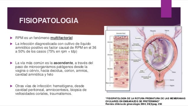 Ruptura Prematura de Membranas