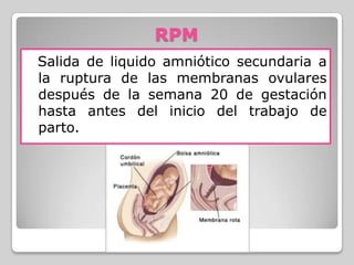RPM
Salida de liquido amniótico secundaria a
la ruptura de las membranas ovulares
después de la semana 20 de gestación
hasta antes del inicio del trabajo de
parto.
 