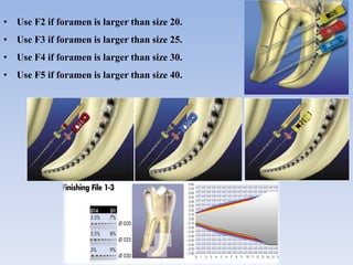 • Use F2 if foramen is larger than size 20.
• Use F3 if foramen is larger than size 25.
• Use F4 if foramen is larger than size 30.
• Use F5 if foramen is larger than size 40.
 