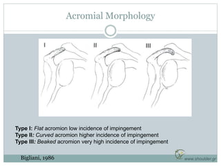 www.shoulder.gr
Acromial Morphology
Type I: Flat acromion low incidence of impingement
Type II: Curved acromion higher inc...