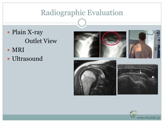www.shoulder.gr
Radiographic Evaluation
 Plain X-ray
Outlet View
 MRI
 Ultrasound
 