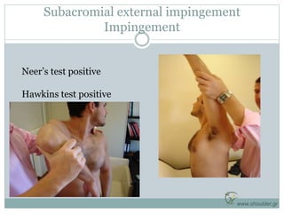 Subacromial external impingement
Impingement
www.shoulder.gr
Neer’s test positive
Hawkins test positive
 
