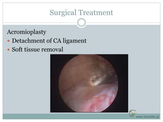 Surgical Treatment
Acromioplasty
 Detachment of CA ligament
 Soft tissue removal
www.shoulder.gr
 